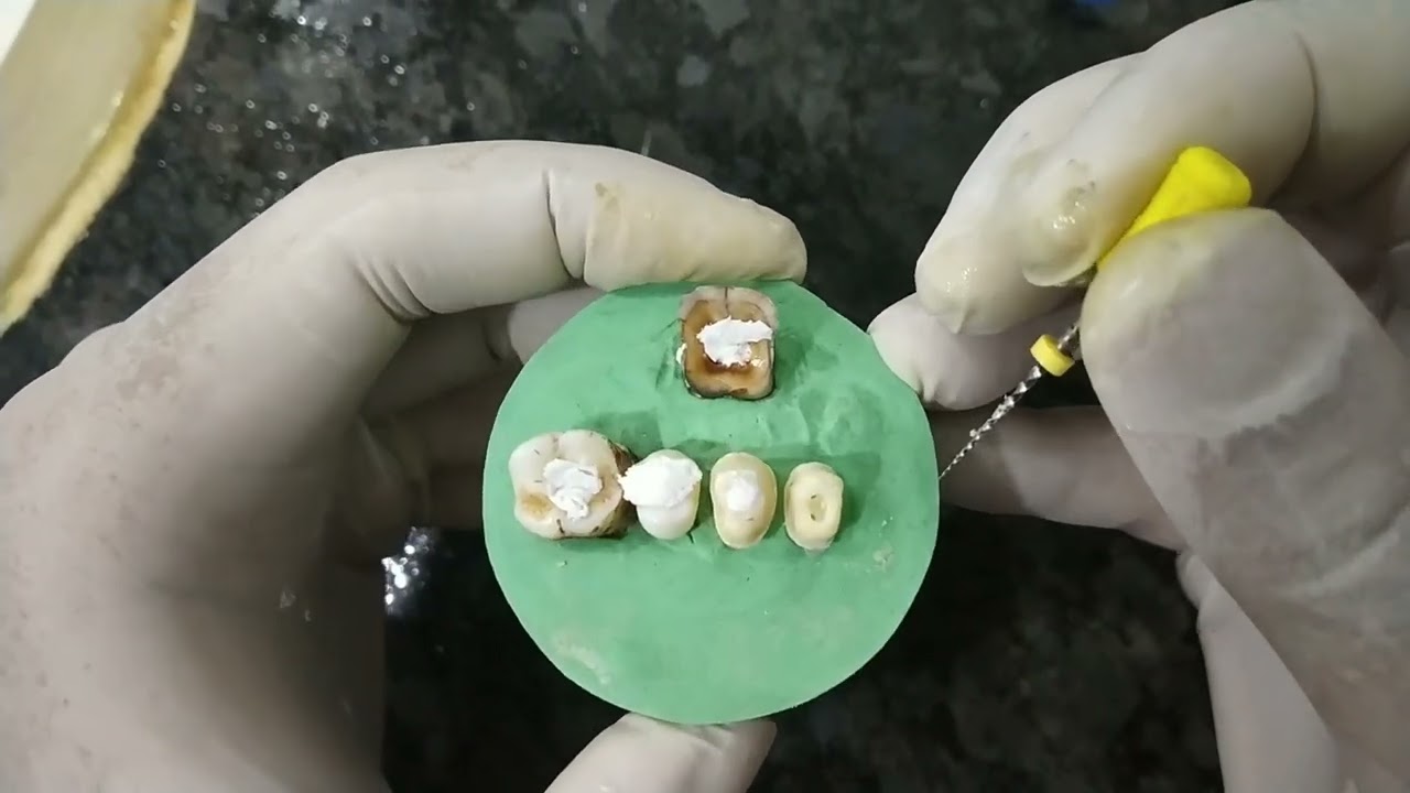 HOW TO DO RCT USING ENDOMOTOR