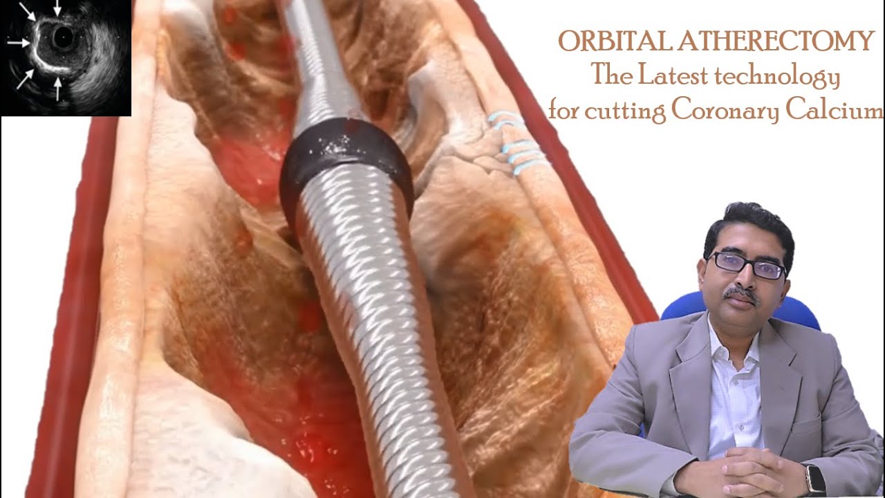 ORBITAL ATHERECTOMY - The Latest Technology for Coronary Calcium