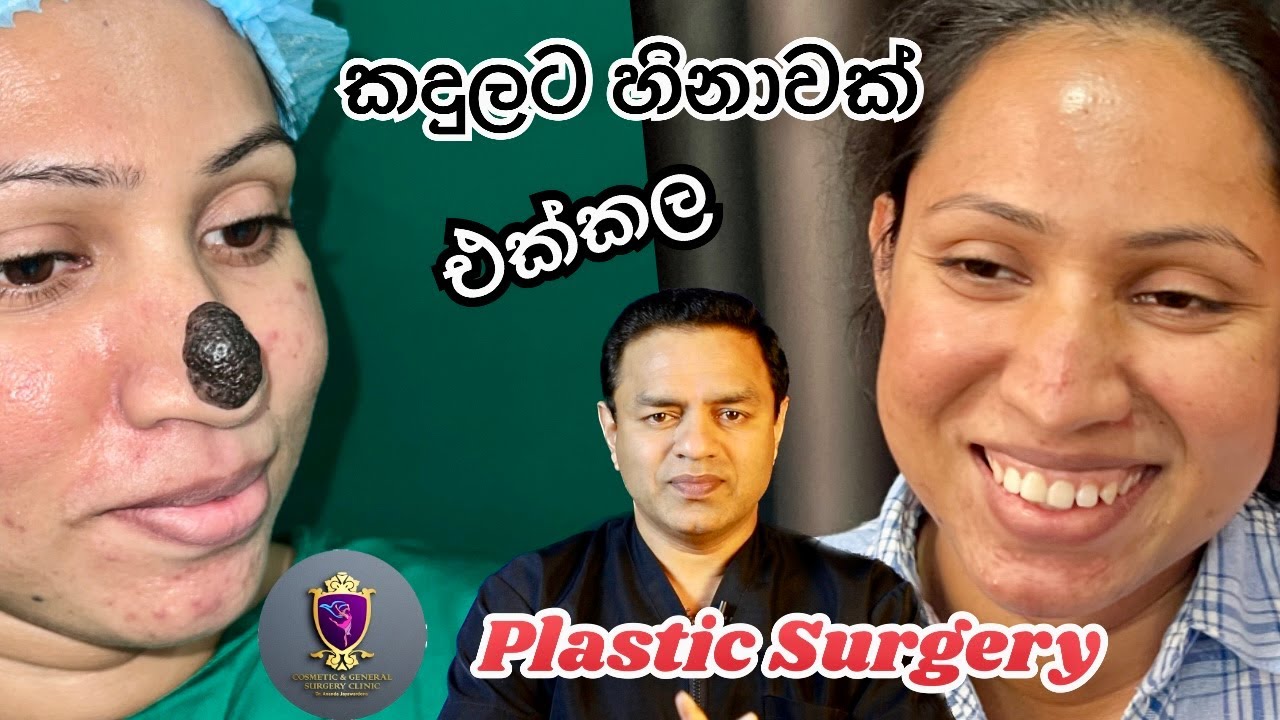 Birthmark removal උපන්ලප ඉවත්කල විශ්මිත සැත්කම Dr Ananda Jayawardena best plastic Surgery Dr Ananda
