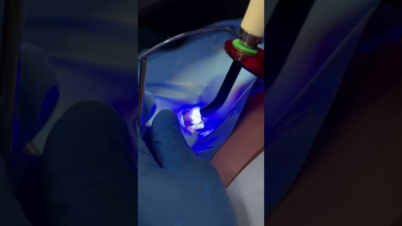 Cavity preparation: Amalgum Vs. Composite