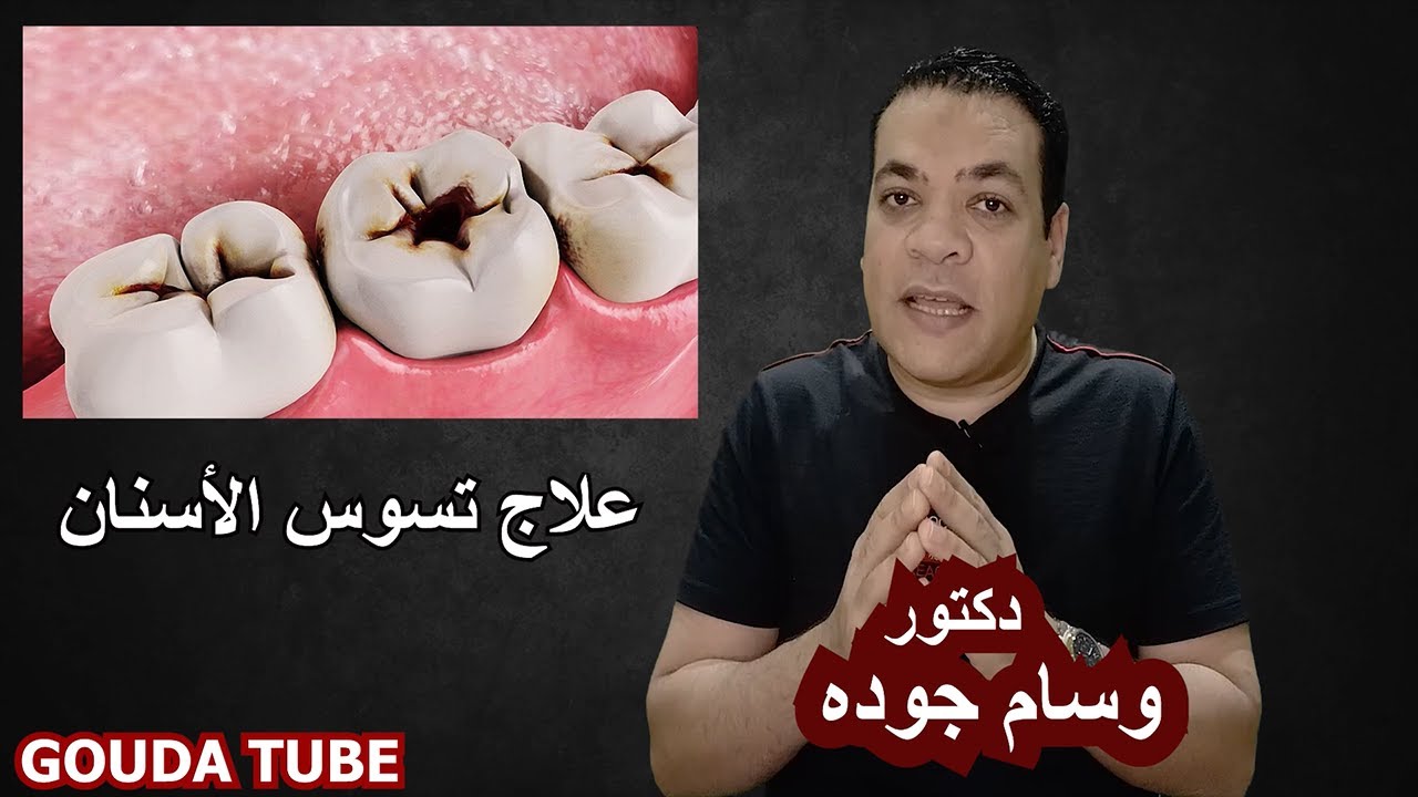 علاج تسوس الاسنان نهائيا فى خمسة دقائق بدون بنج | دكتور وسام جوده