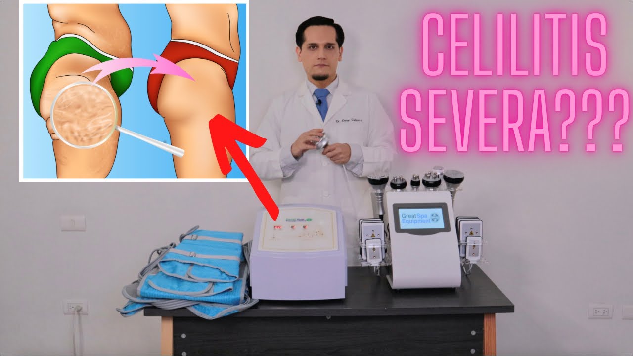 COMO ELIMINAR LA CELULITIS SEVERA