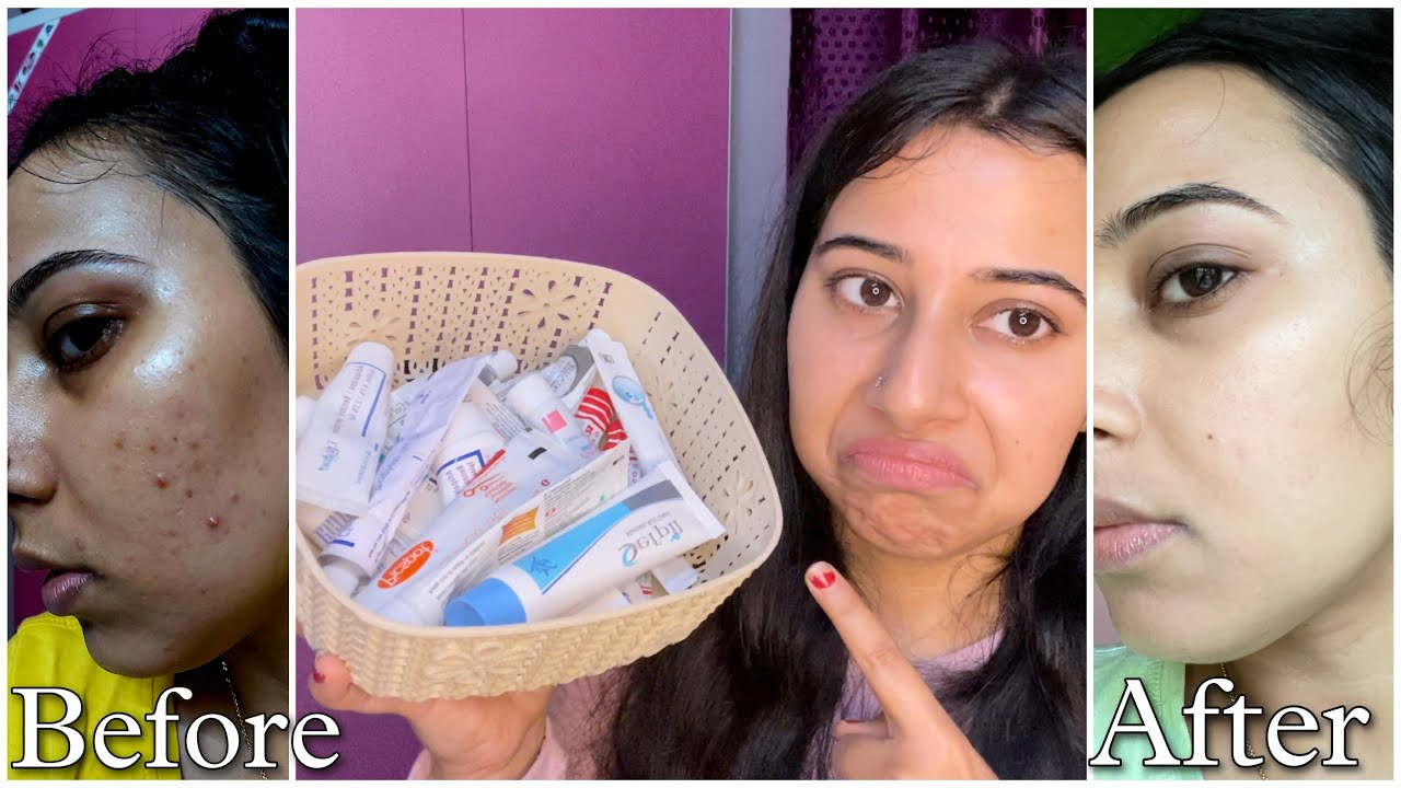 All Medicated Creams I have tried Since last 8 Years to remove Pimples & Pimple Marks & What Worked