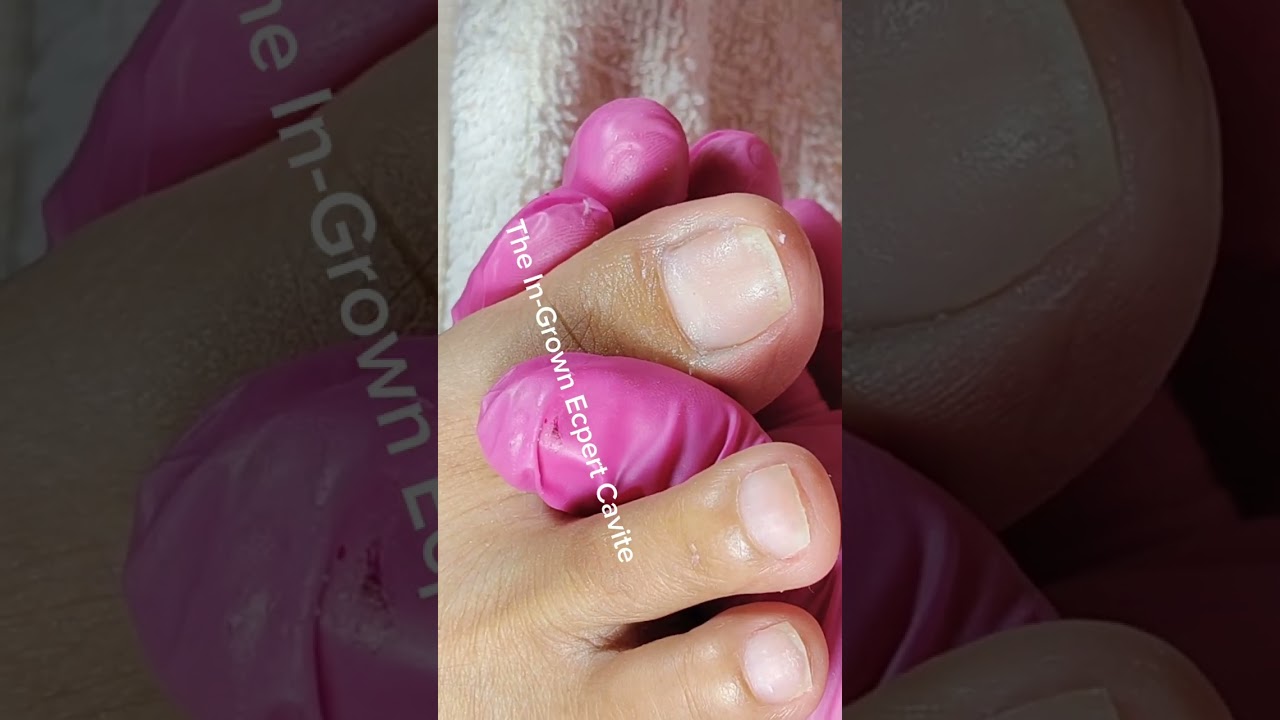 Full video pedicure with ingrown removal