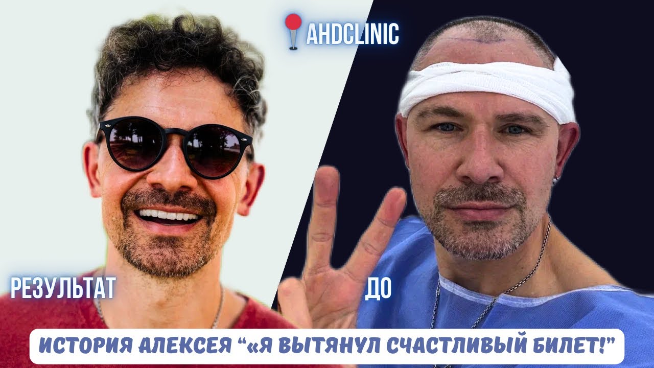 История пересадки волос Алексея «Я вытянул счастливый билет!». До и после в клинике доктора Доганай