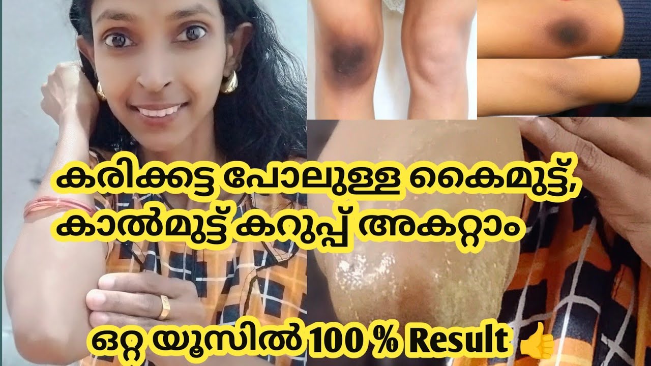 എളുപ്പത്തിൽ കൈമുട്ട്, കാൽമുട്ട് കറുപ്പ് അകറ്റാം| Skinwhitening Tip for Dark knee & Elbows💯👍
