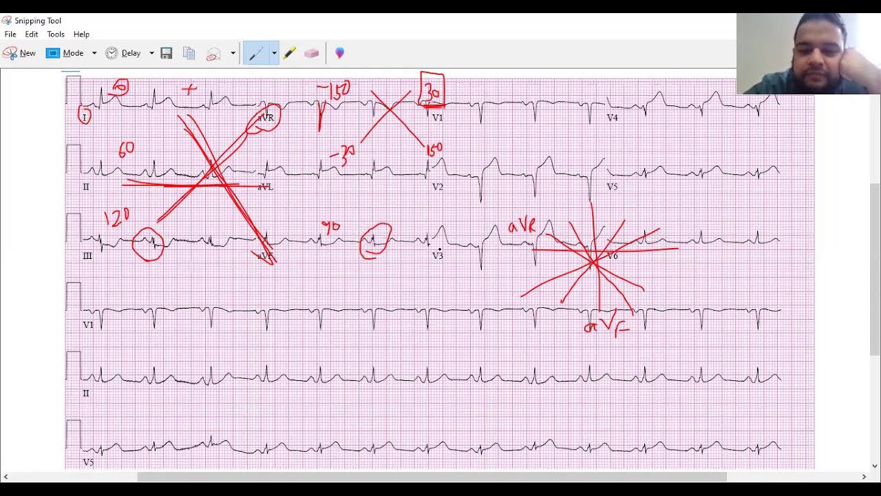 Determining axis of EKG (isoelectric method) practice tracings