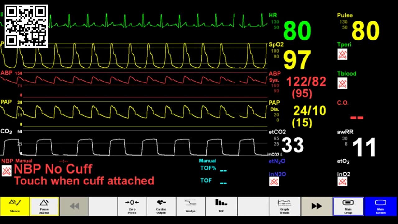 Timed Simulated Patient ICU Monitor