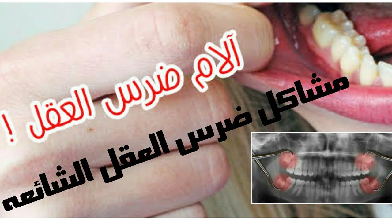 مشاكل ضرس العقل المدفون(impacted wisdom teeth)