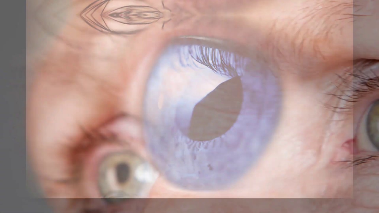 Glaucoma LIma Center