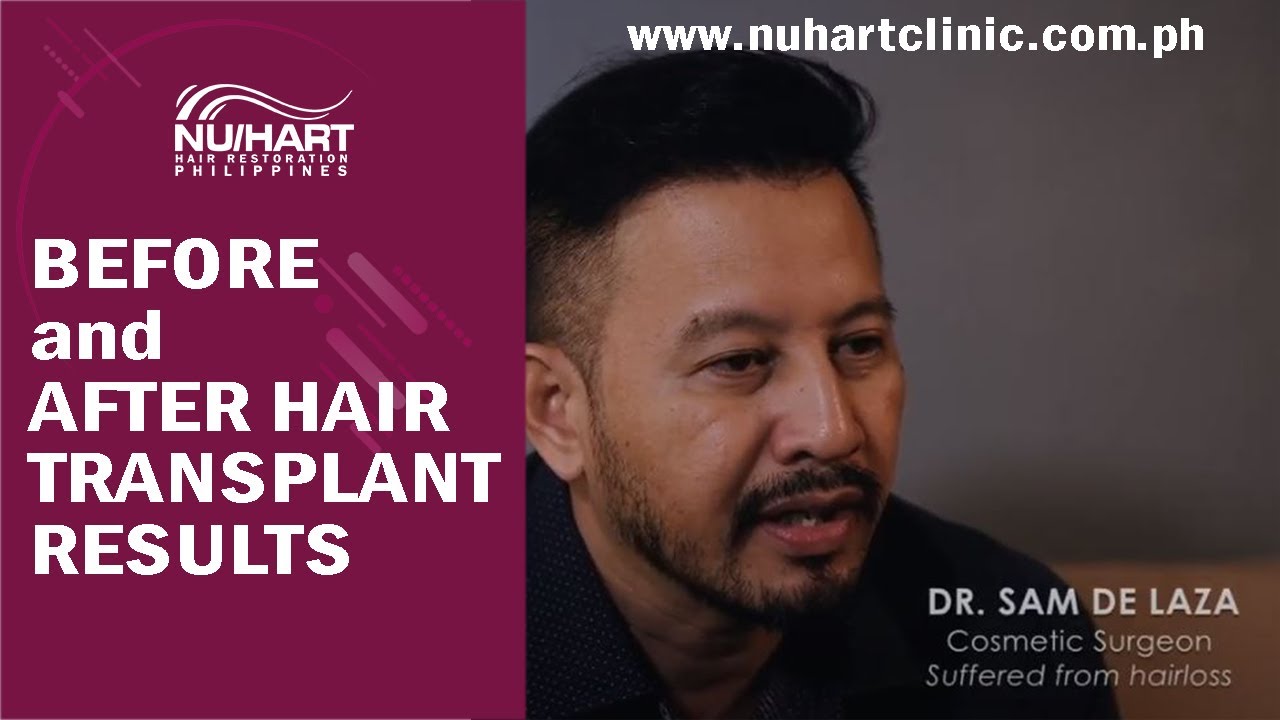 Sam's Hair Restoration Journey at NU/HART