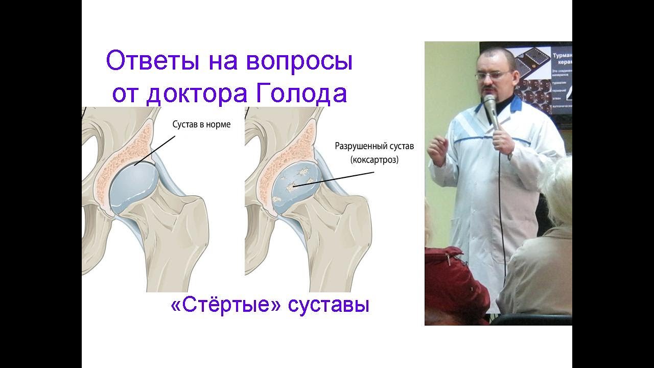 Стёртые суставы: как лечить – ответ от доктора Голода