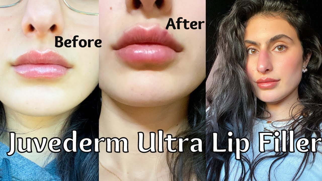 JUVEDERM ULTRA LIP FILLER! 1 SYRINGE (my experience + healing process)