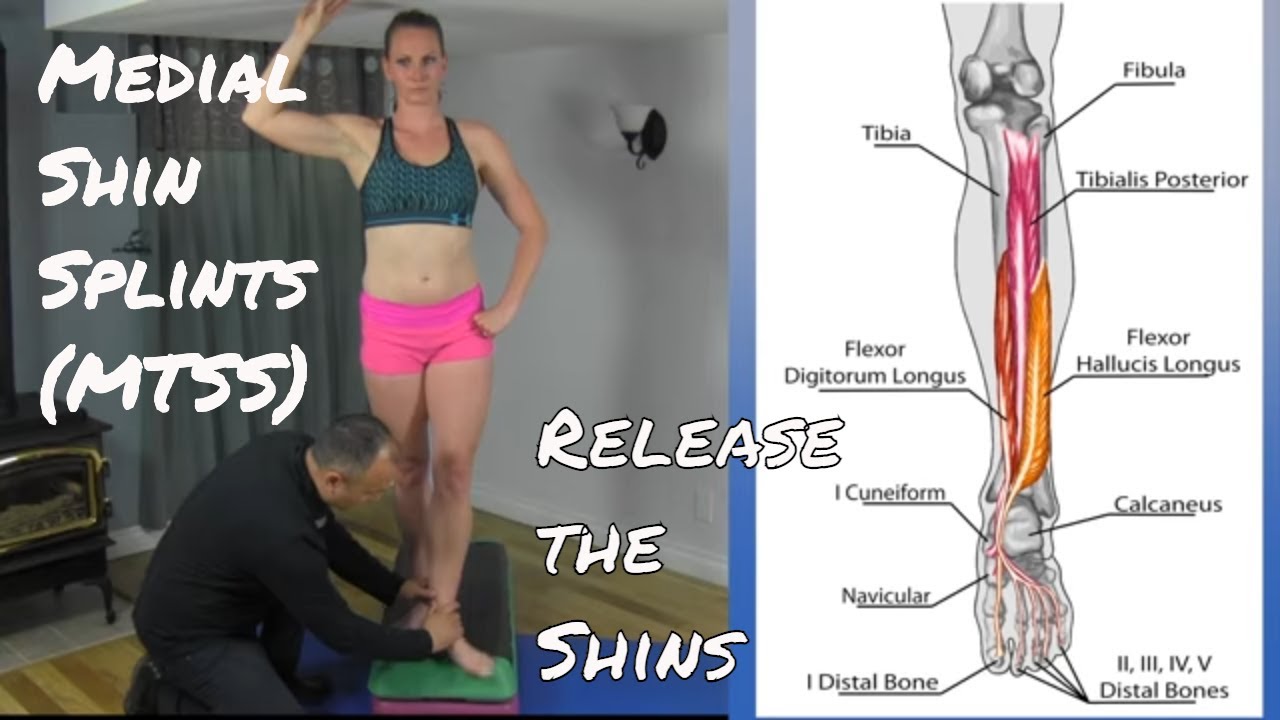 Resolving Medial Shin Splints (MTSS)