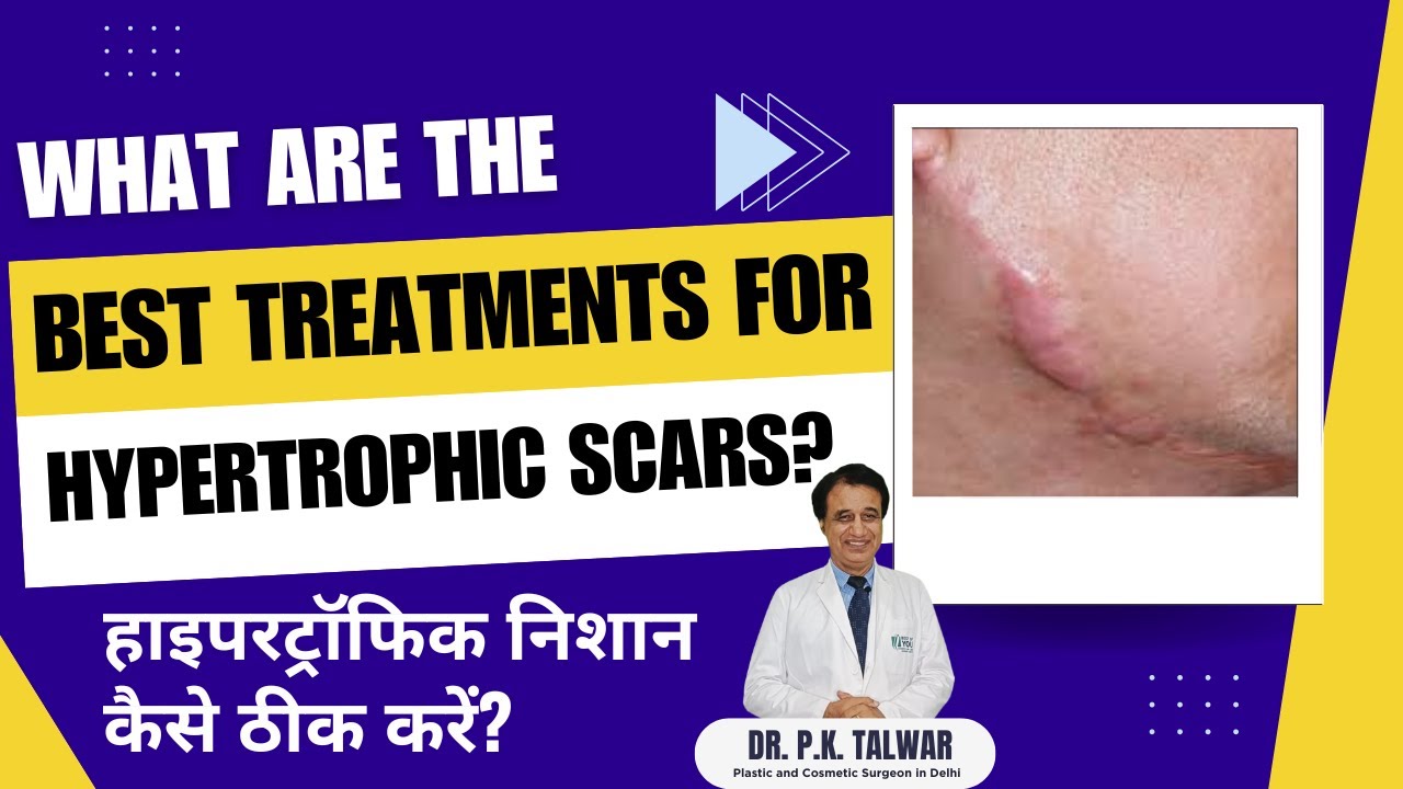 Best Treatment for Hypertrophic Scars on Face | Scar Treatment Clinic In Delhi | Dr. PK Talwar