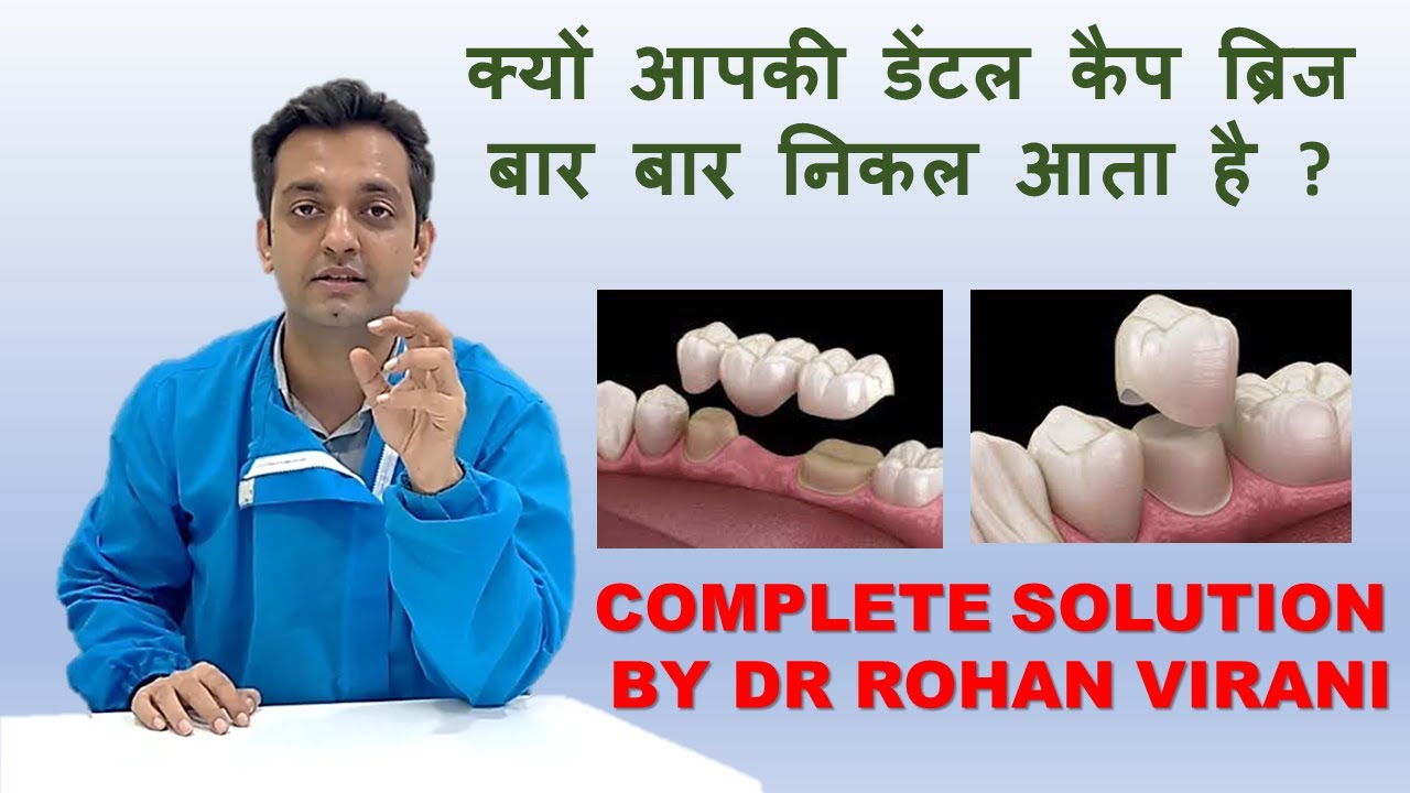 क्यों आपकी डेंटल कैप ब्रिज बार बार निकल आता है ? - Complete Solution By Dr Rohan Virani