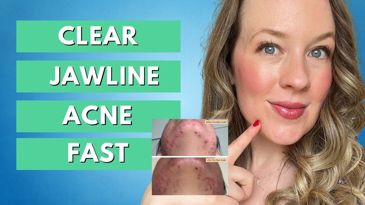 Jawline Acne - CLEAR CYSTIC ACNE ON JAWLINE FAST!