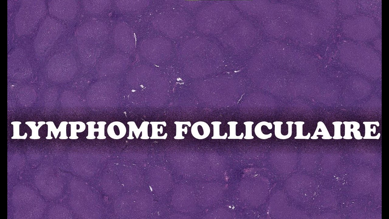 LE LYMPHOME FOLLICULAIRE - PATHOLOGIE