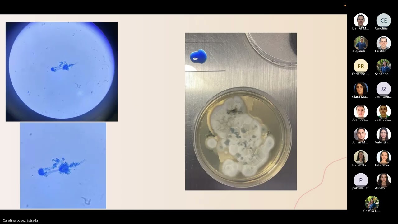 Sinusitis esfenoetmoidal