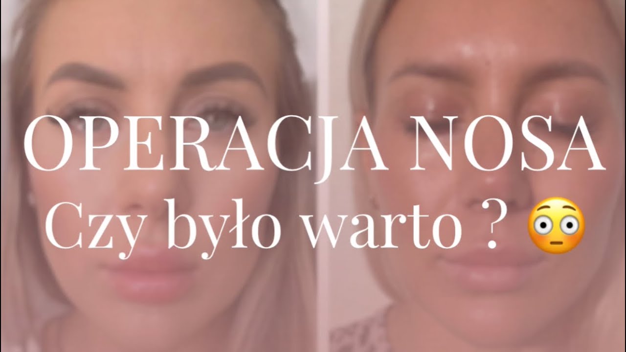 Moja operacja nosa | dr Pinar | Turcja | Czy było warto ? 