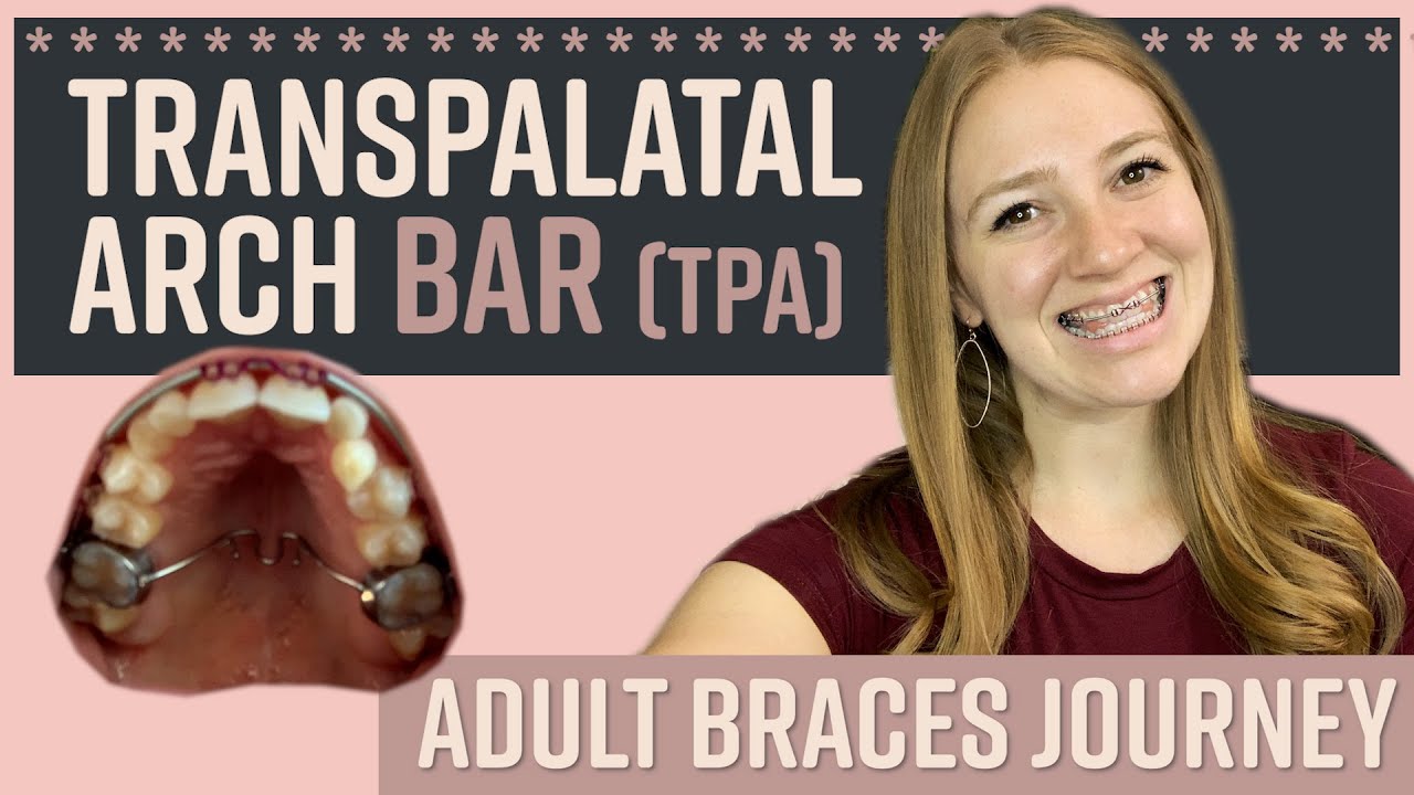 Adult Braces Journey 6: TRANSPALATAL ARCH FOR BRACES| BAR | TPA