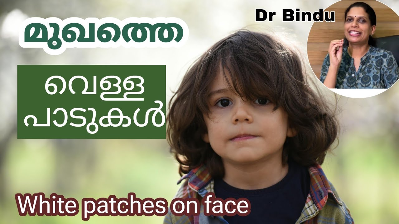 മുഖത്തെ വെളുത്ത നിറത്തിലുള്ള പാടുകൾ/Whitish patches over face in children Dr Bindu