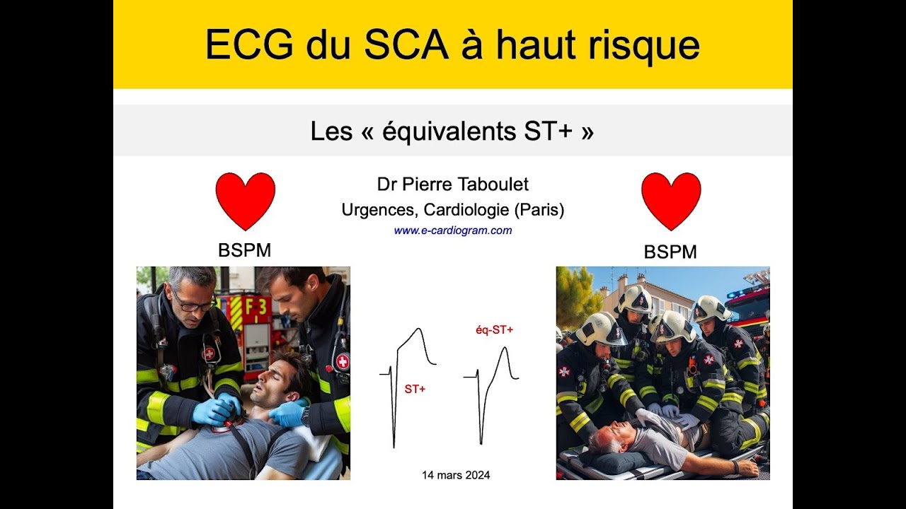 ECG du syndrome coronaire aigu. Les équivalents ST+ à haut risque. P. Taboulet