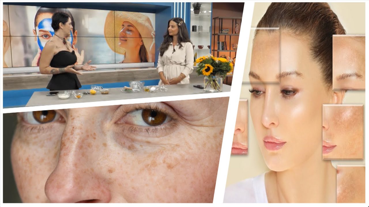 Rezultat që do ju habisë | Ke njolla kafe nga dielli? Provo këtë maskë me zero lekë që bën mrekulli