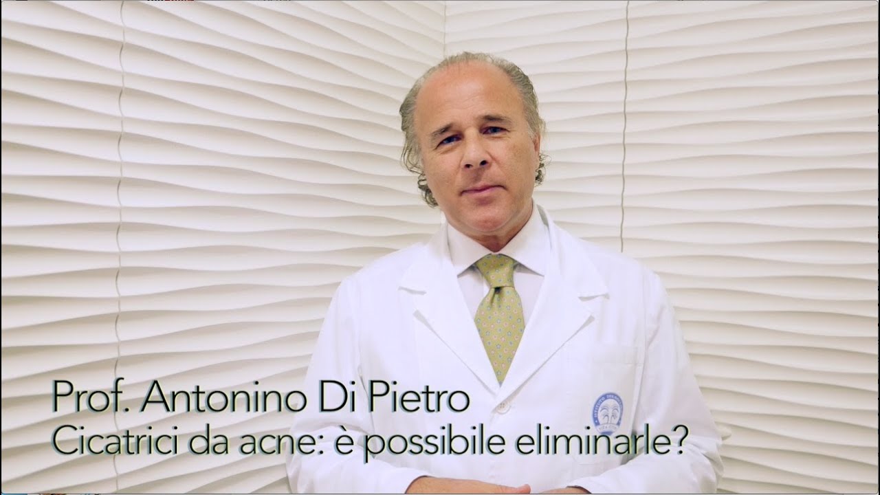 Cicatrici da acne: è possibile eliminarle? - Prof. Antonino Di Pietro