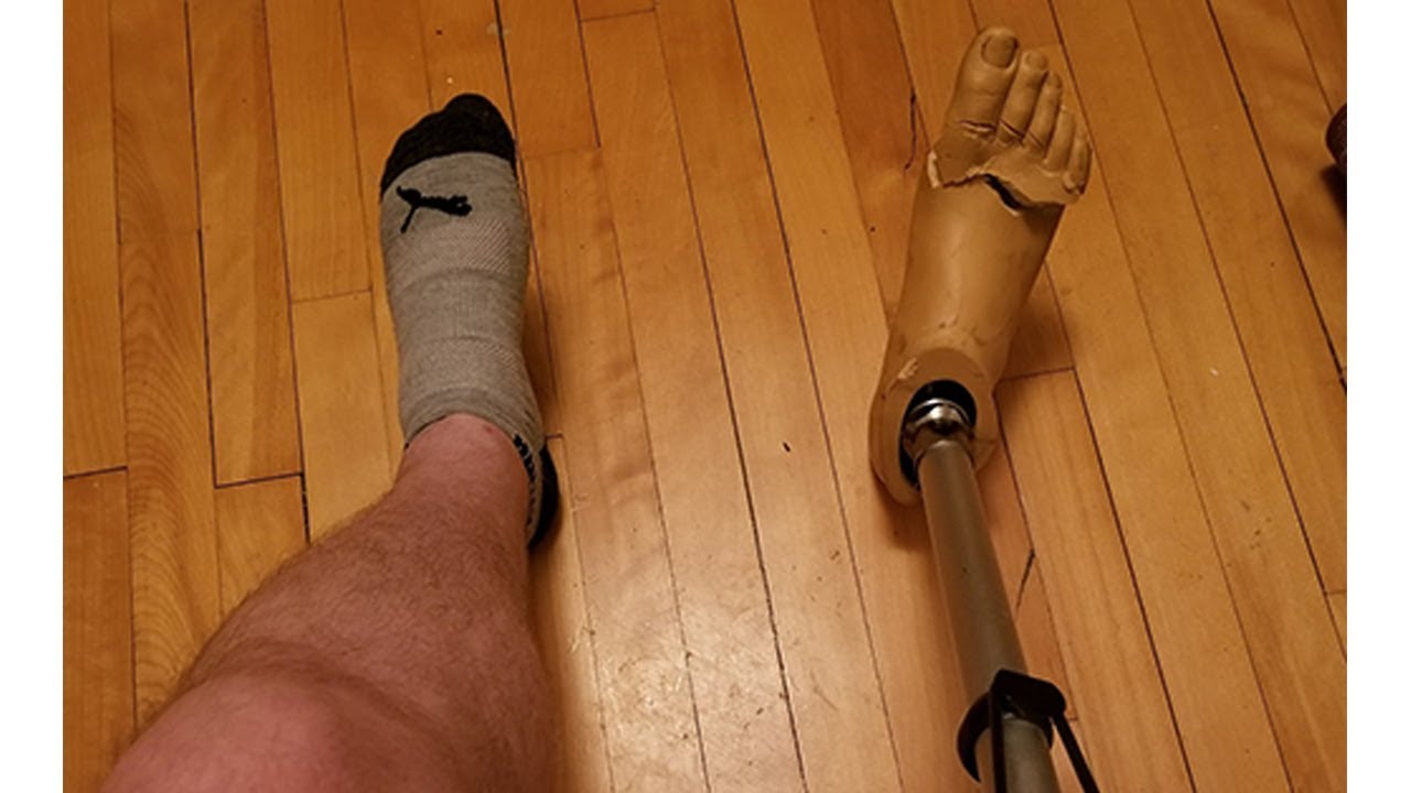 OH NO! PROSTHETICS GOT BROKEN!!!
