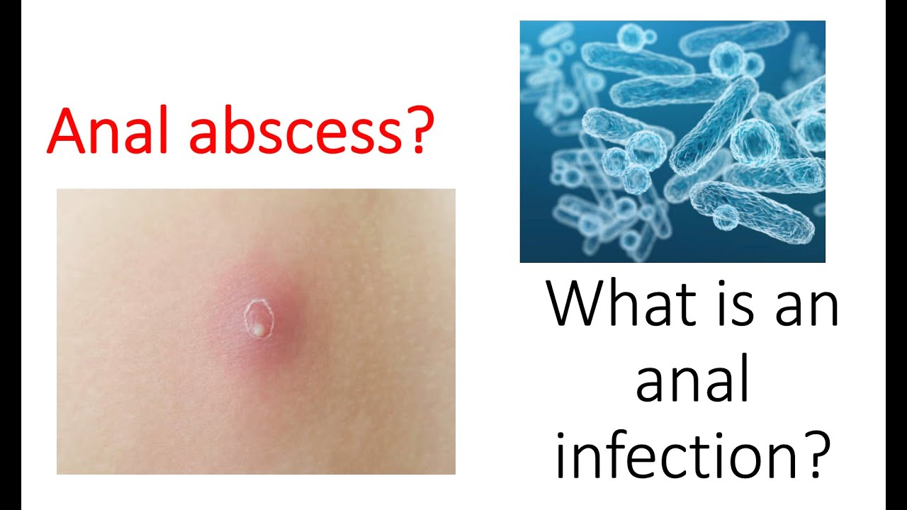 Infection in your anus? What is a rectal or anal abscess? Learn from an expert!