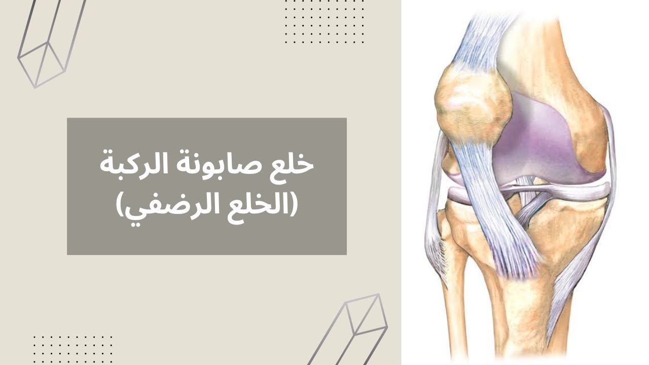 خلع الصابونة : الخلع الرضفي