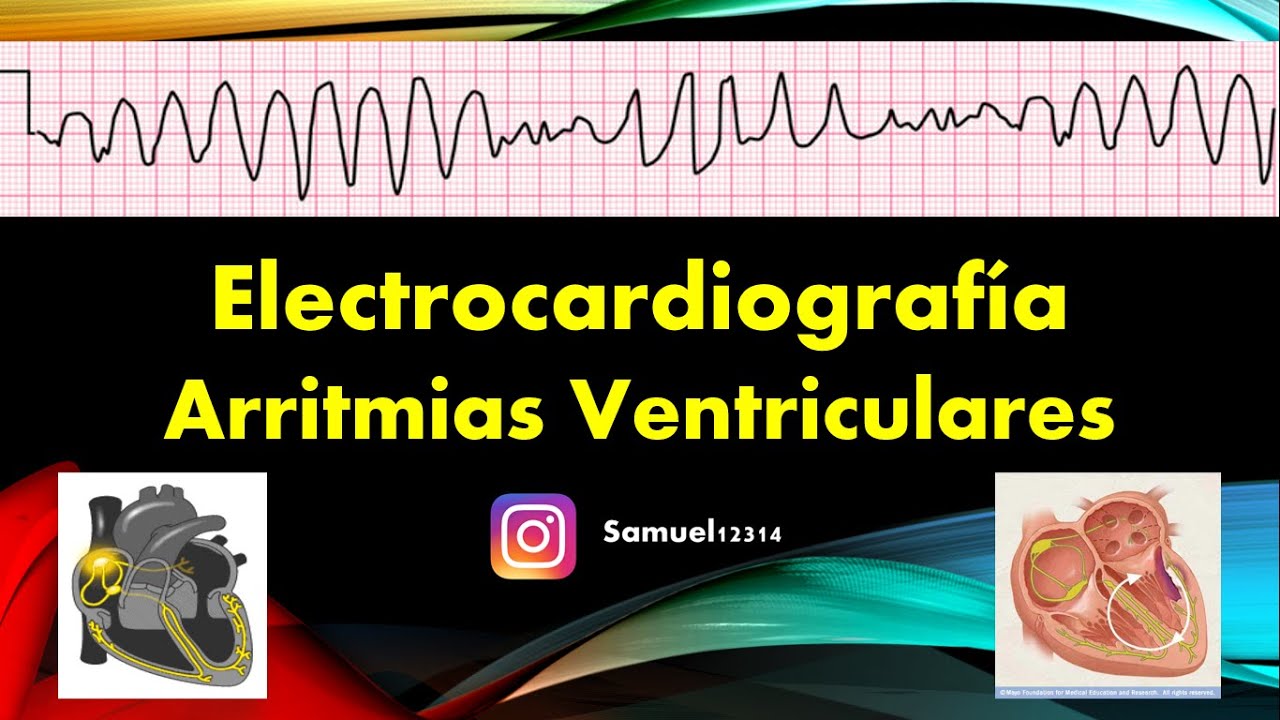 🏅 ARRITMIAS VENTRICULARES 🫀 - ELECTROCARDIOGRAMA (11)