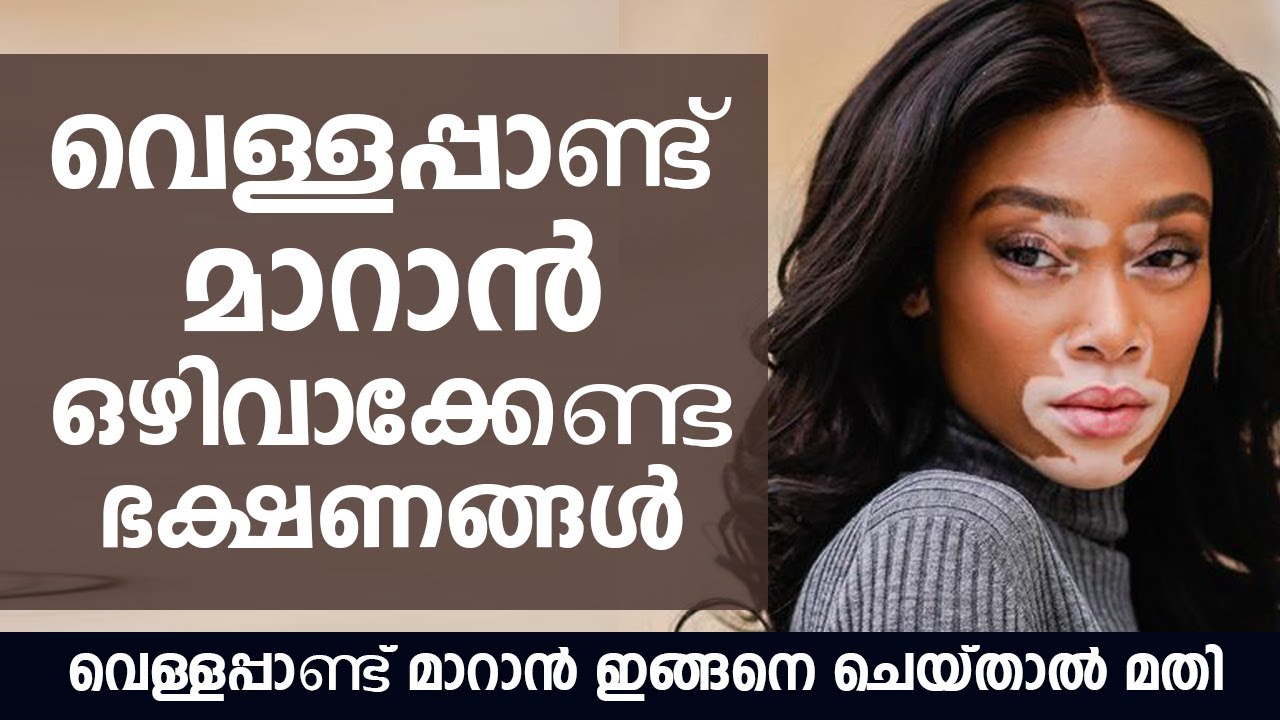 വെള്ളപ്പാണ്ട് മാറാൻ ഇങ്ങനെ ചെയ്താൽ മതി | Vitiligo Treatment Malayalam
