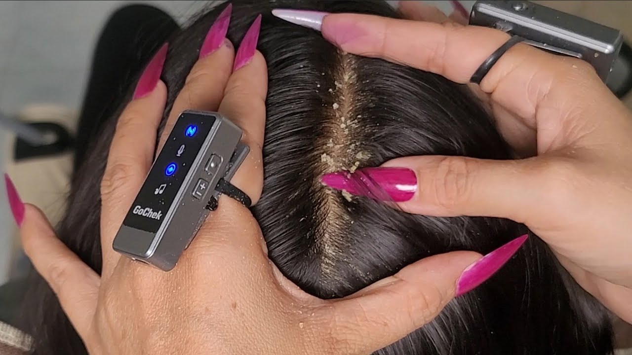 Ultimate Scalp Tingle Therapy ASMR 🌙 | Heavy Flakes, Slow Scratching & Deep Relief #DN622