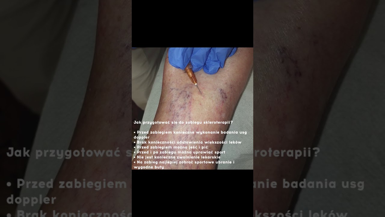Skleroterapia