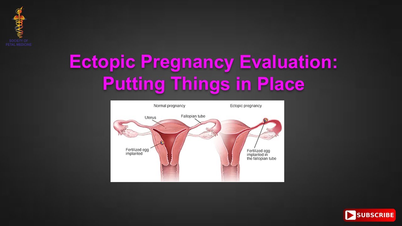 Ectopic Pregnancy Evaluation: Putting Things in Place
