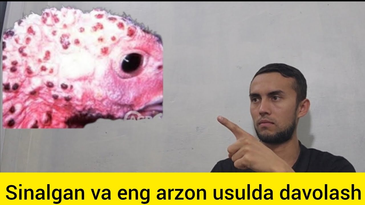 CHECHAKNI DAVOLASHNI YANGI VA SINALGAN USULI
