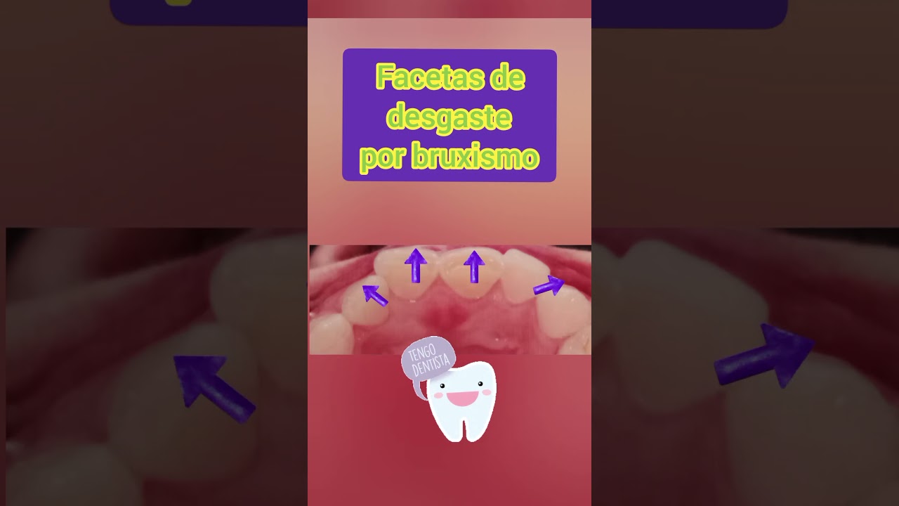 #desgaste en los #dientes por apretar y rechinar