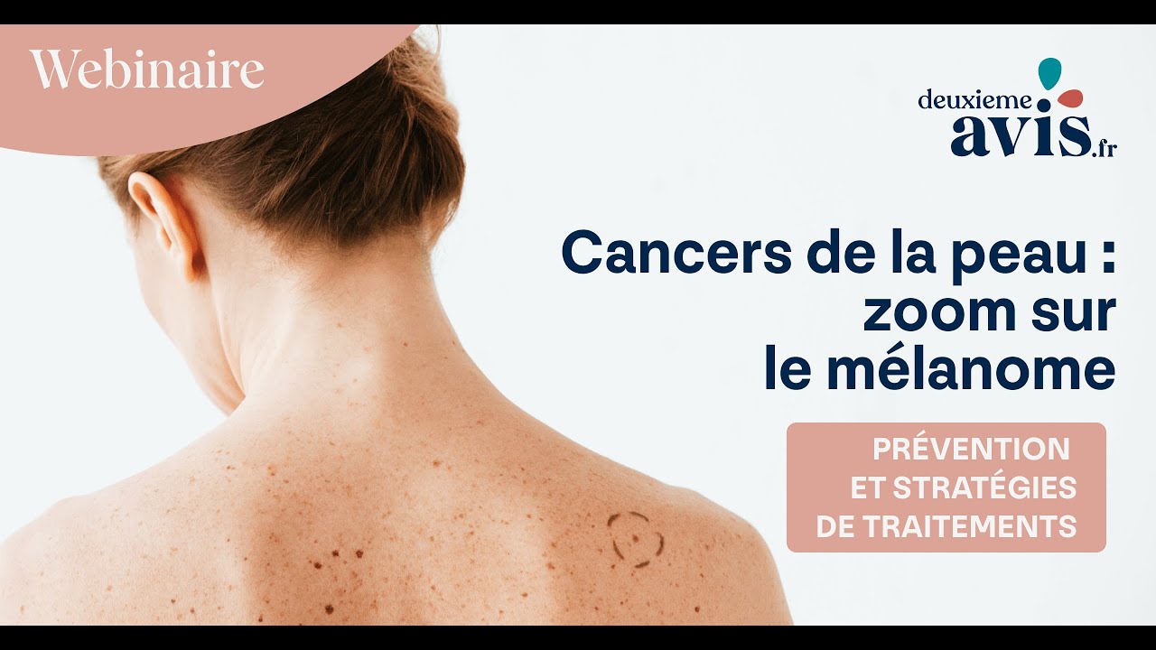 Cancers de la peau, zoom sur le m&eacute;lanome : pr&eacute;vention et strat&eacute;gies de traitement