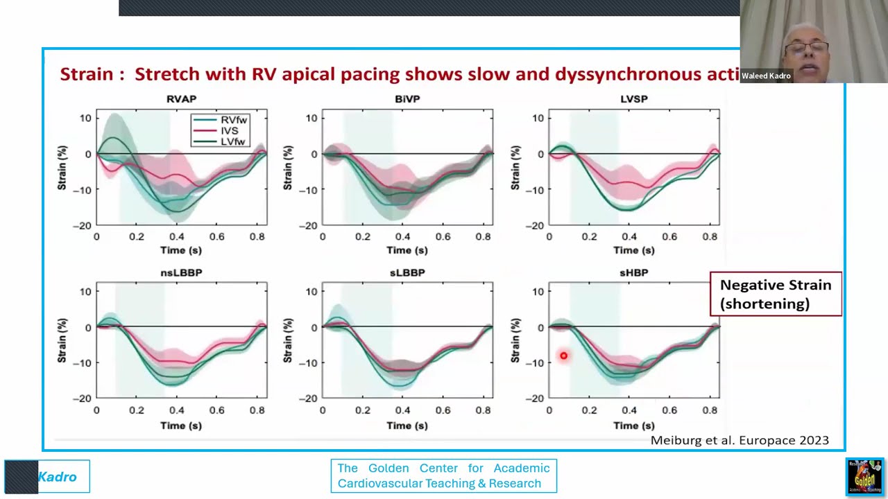 Conduction system pacing and left bundle area pacing