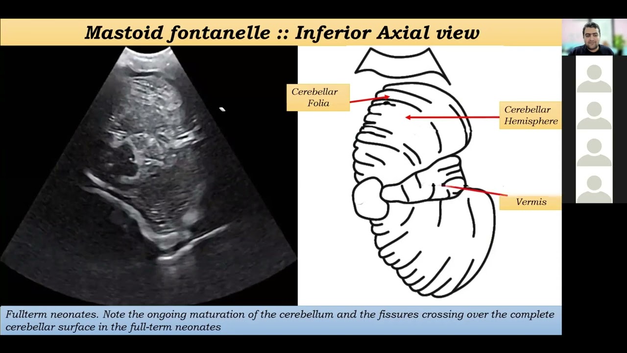 Part 6 :: Neonatal Cranial sonography:: Mastoid planes .. Posterior fossa :: Dr.Mohamed Soliman