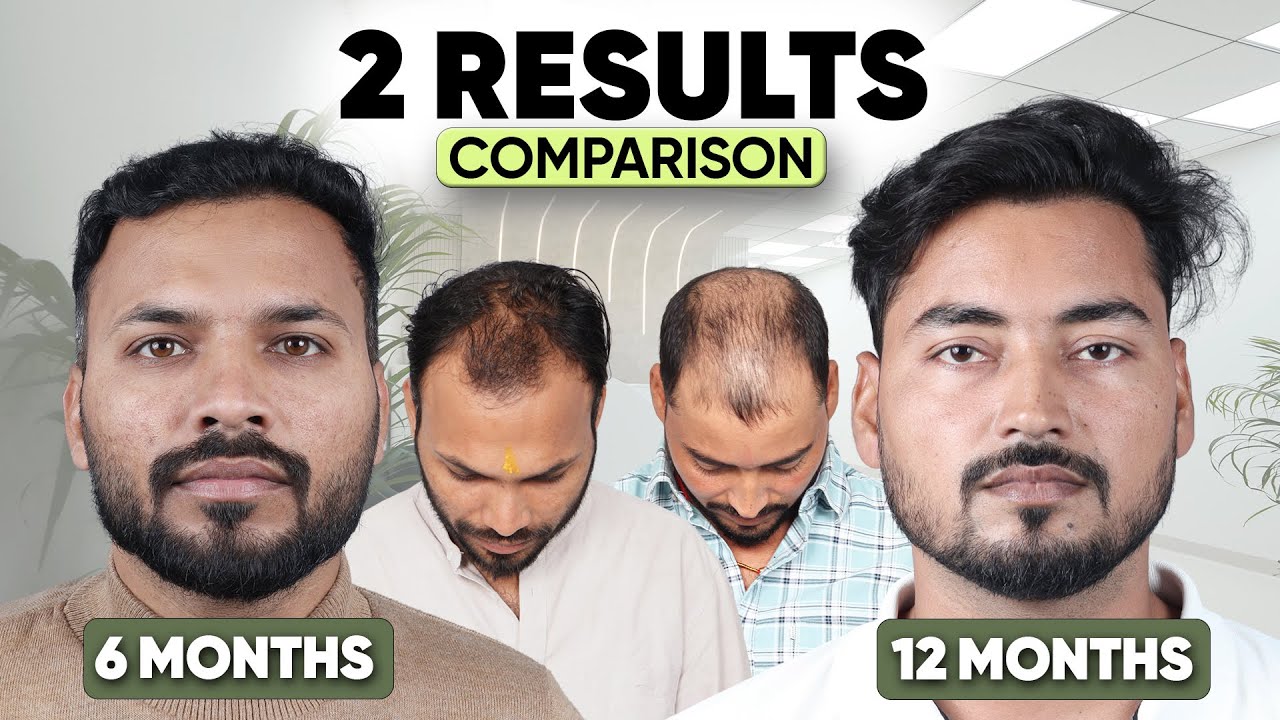 Hair Transplant in Kanpur (HX-SAGY) | Best Results & Cost of Hair Transplant in Kanpur.