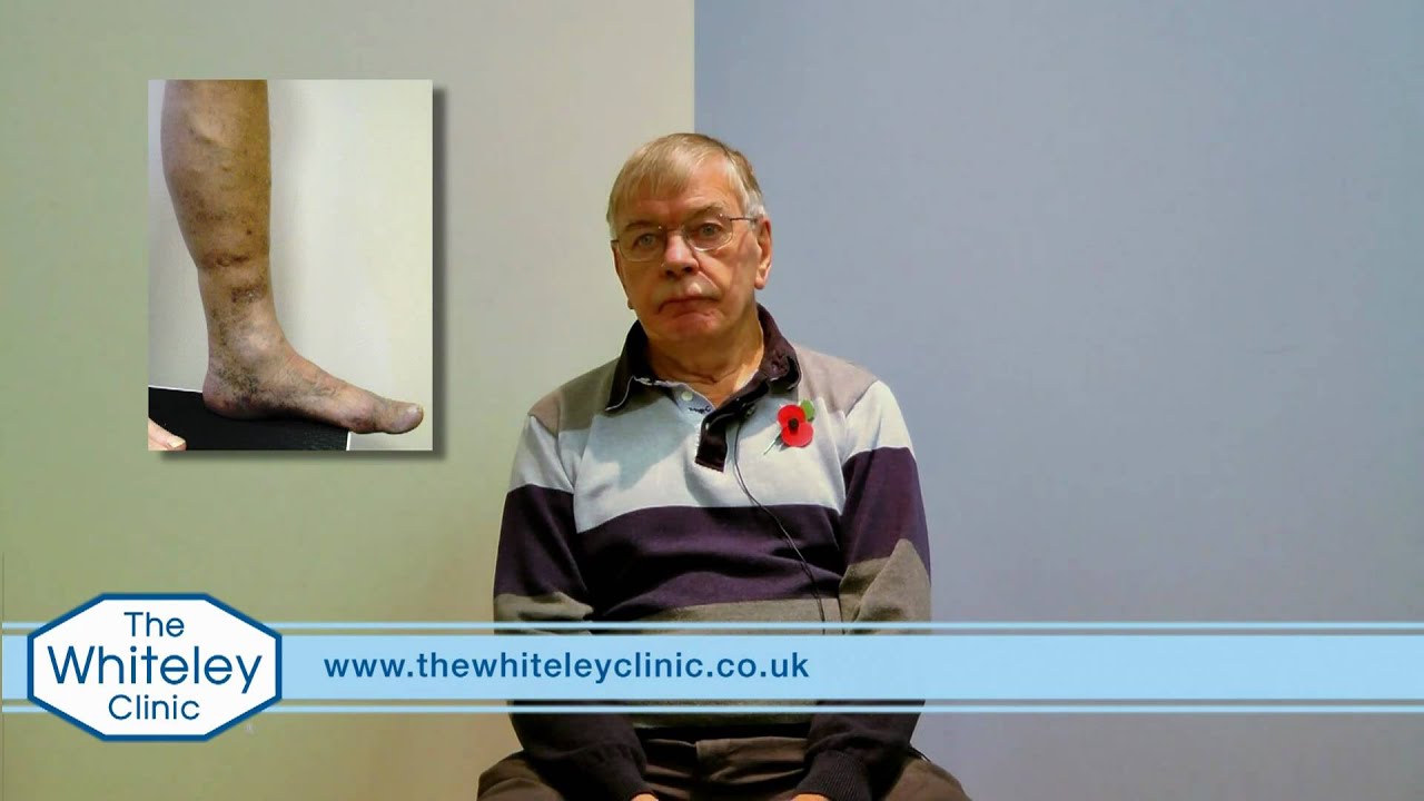 Venous eczema and varicose veins treated by The Whiteley Protocol®