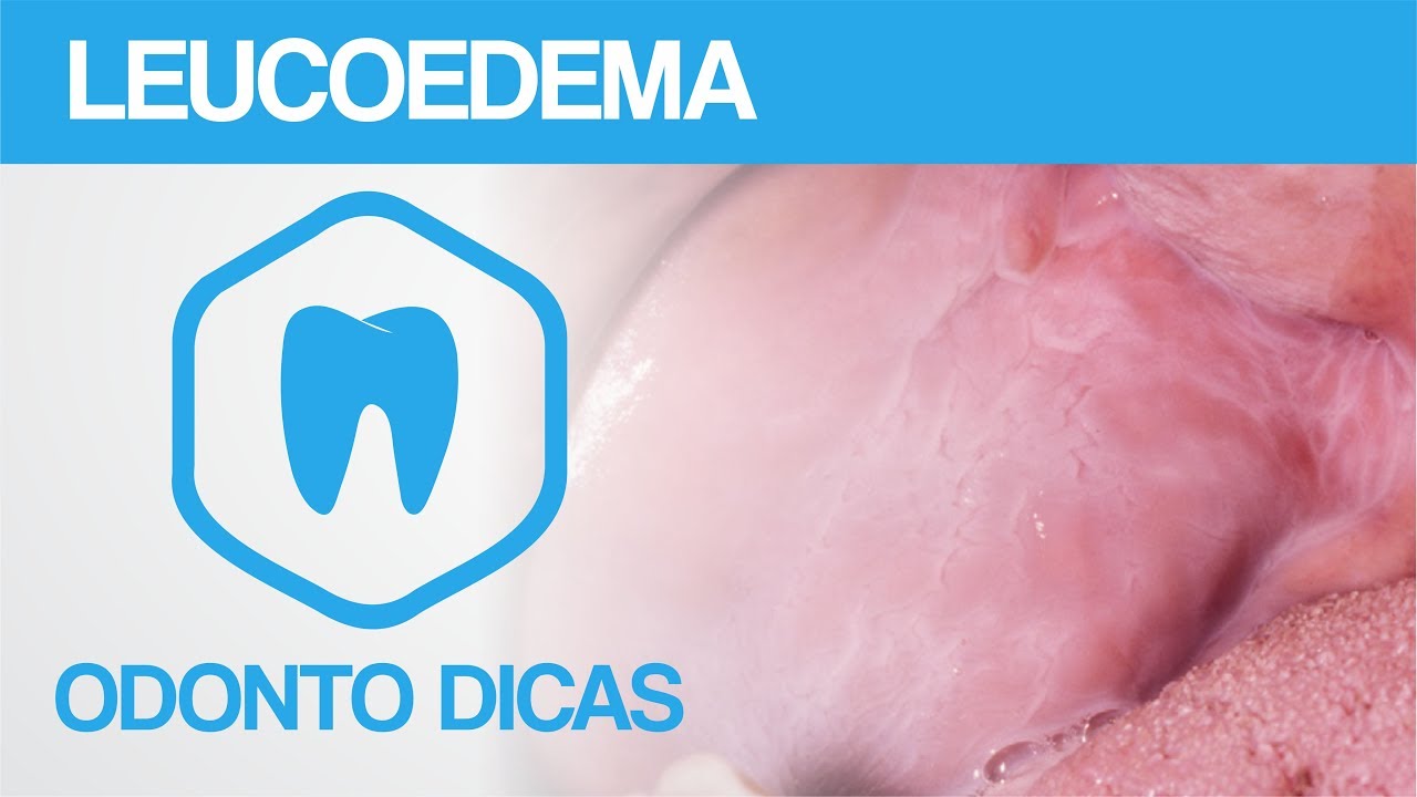 LEUCOEDEMA | ODONTO DICAS