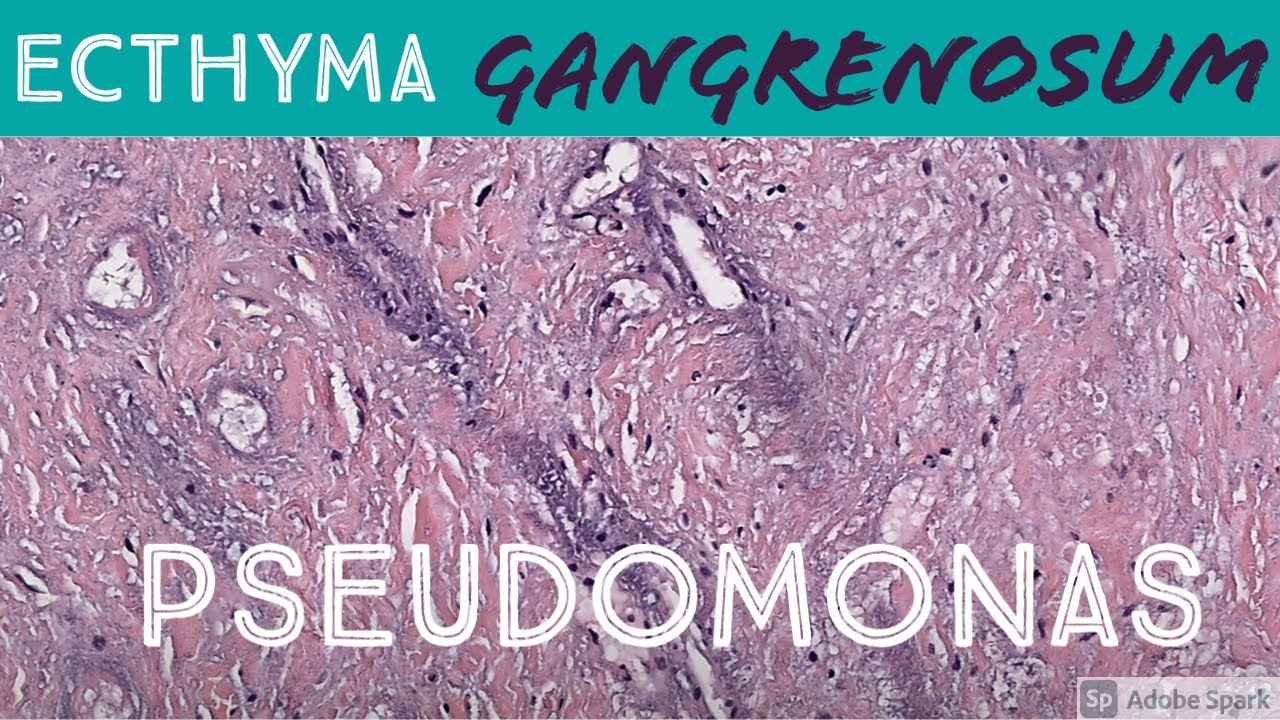 Ecthyma Gangrenosum (Pseudomonas aeruginosa) 5-Minute Pathology Pearls Dermatology Dermatopathology