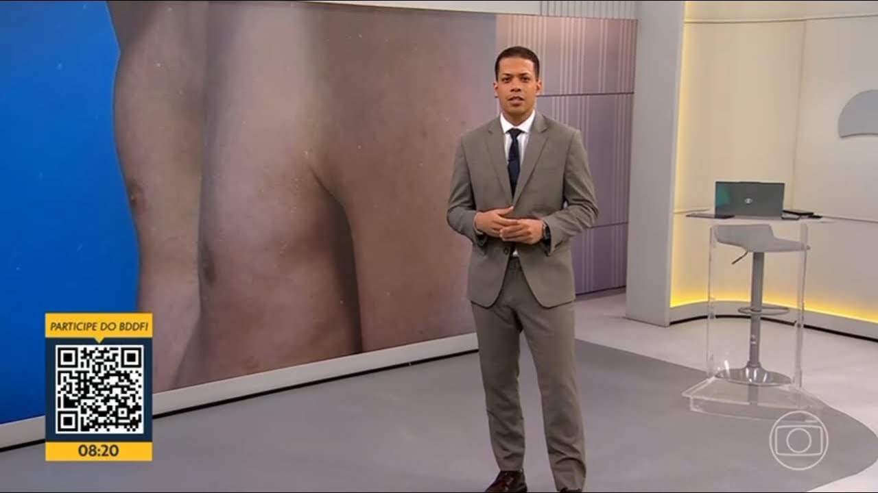 Tratamento de pectus sem cirurgia pelo método Haje 