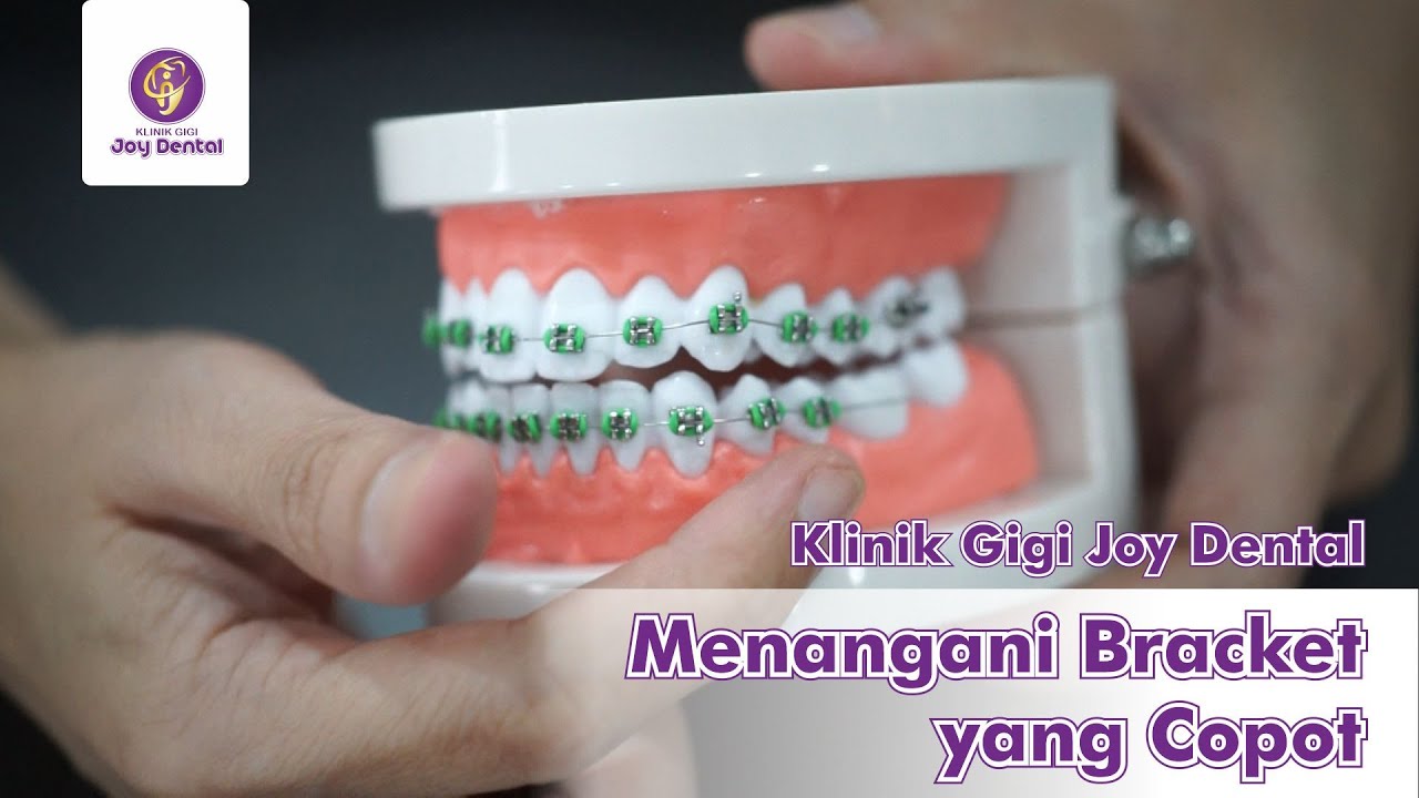 Penting! Tutorial Mengatasi Bracket yang Lepas Selama Masa Pandemi - Hanya untuk keadaan EMERGENCY