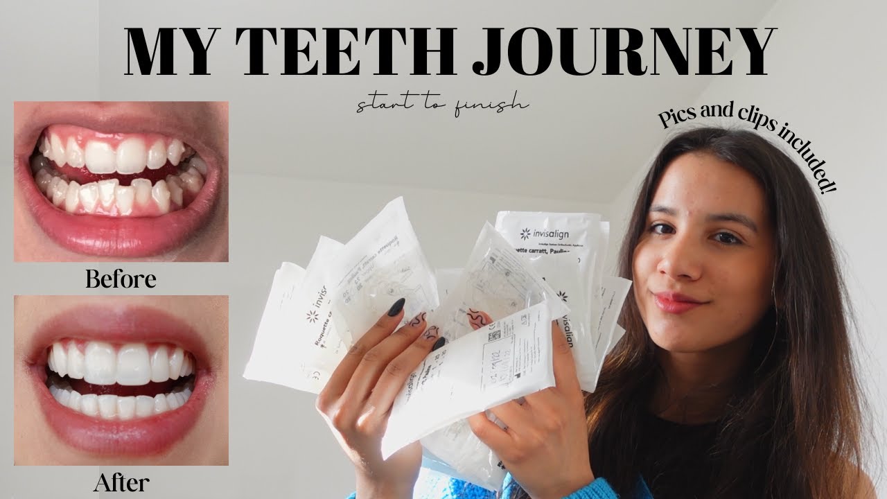 ПУТЬ К МОИМ ЗУБАМ | Invisalign, композитная реставрация, отбеливание | Ответы на все ваши вопросы