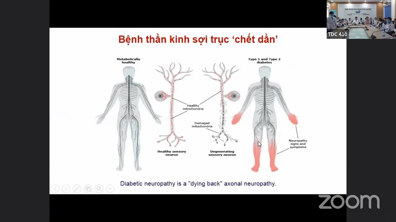 Biến chứng thần kinh Đái tháo đường
